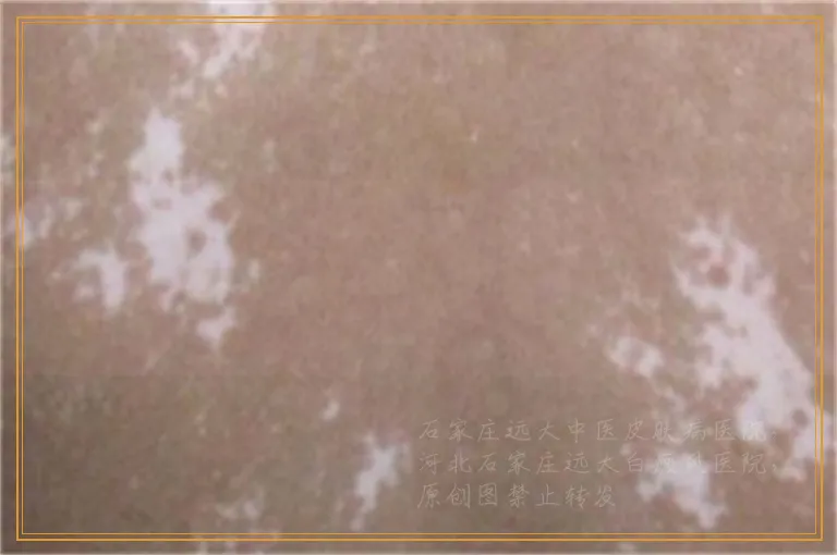 孕妇面部白癜风用什么药效果好