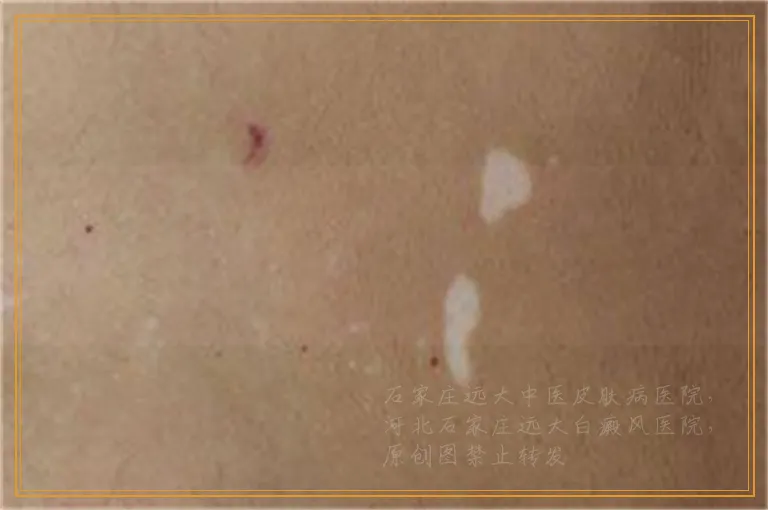 白癜风照光后发红了两天了怎么办