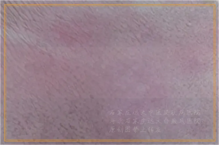 白癜风照光起泡能不能把它弄破