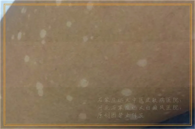 平时用遮盖液对白癜风治疗有影响吗