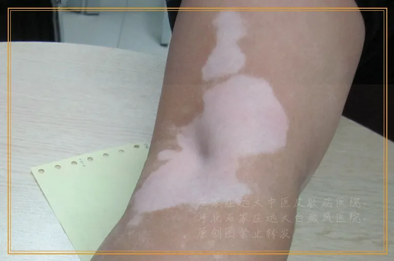 激光治疗白癜风几天照一次好