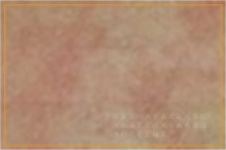 311紫外线光疗仪治疗白癜风效果怎么样