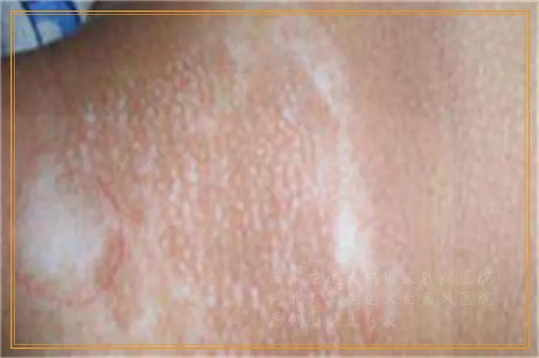 为什么脸部白斑涂他克莫司越来越白