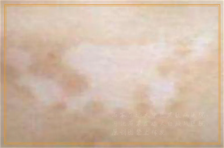 长期吃中药治白癜风会对身体有不良影响吗