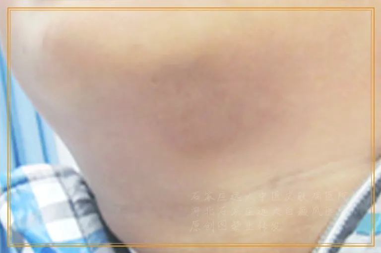 手指白癜风照光后不红是没效果吗