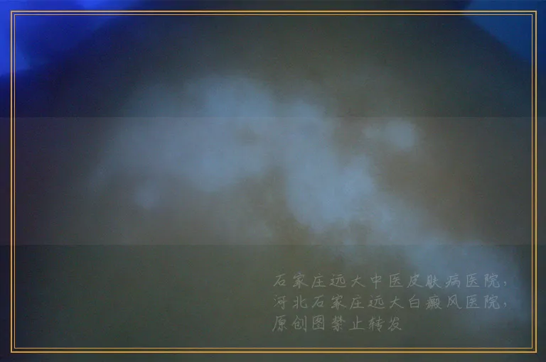 白斑长在肛门附近可以照激光吗