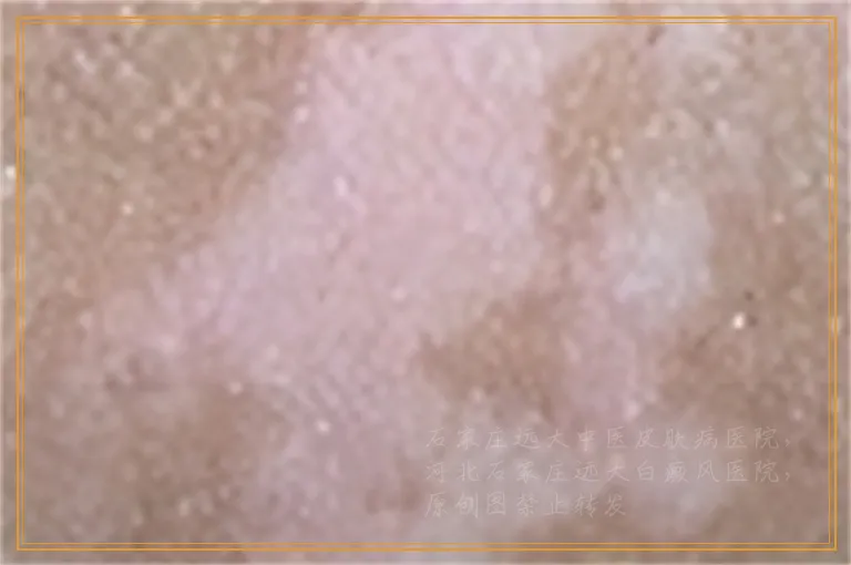 秘方可以治疗白癜风吗