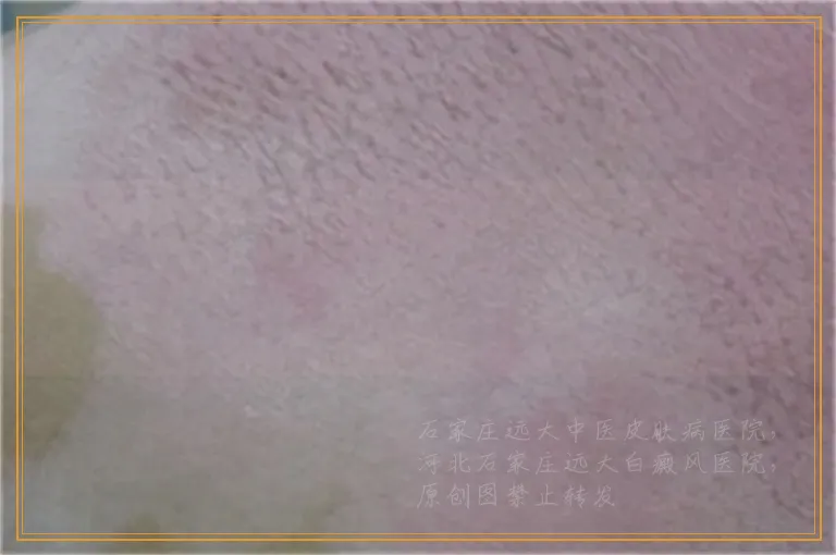 眉毛上的白癜风照几次激光能好