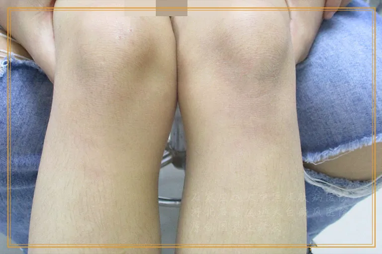 白斑照光以后发黑是正常的吗