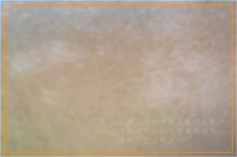 白斑如果连续照光一周会咋样