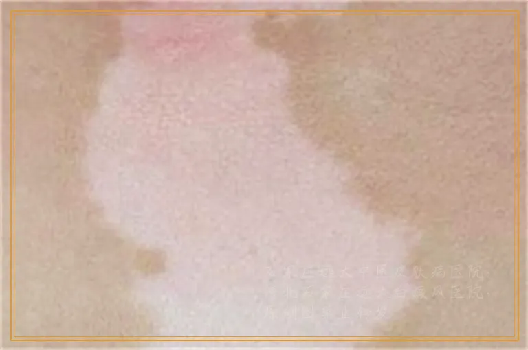 频繁换药治疗白癜风会有哪些危害