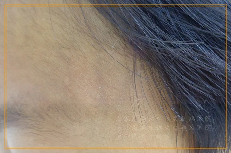 治白癜风有什么药可以替换他克莫司吗