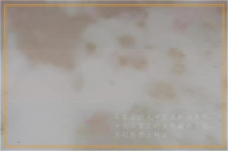 患者如何做到正确治疗白癜风