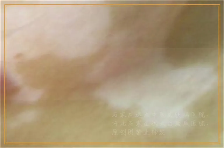 白癜风起水泡还没消照光效果好吗