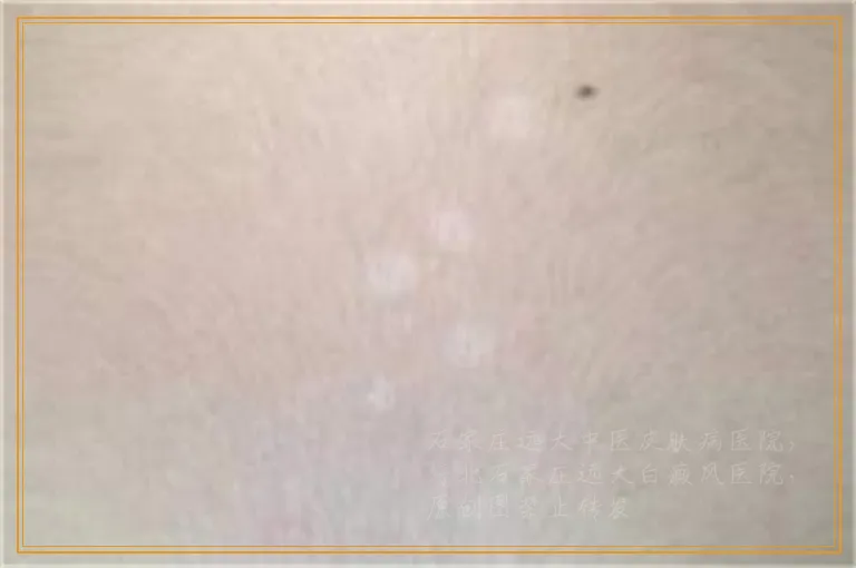 白癜风激光后红还疼是怎么了