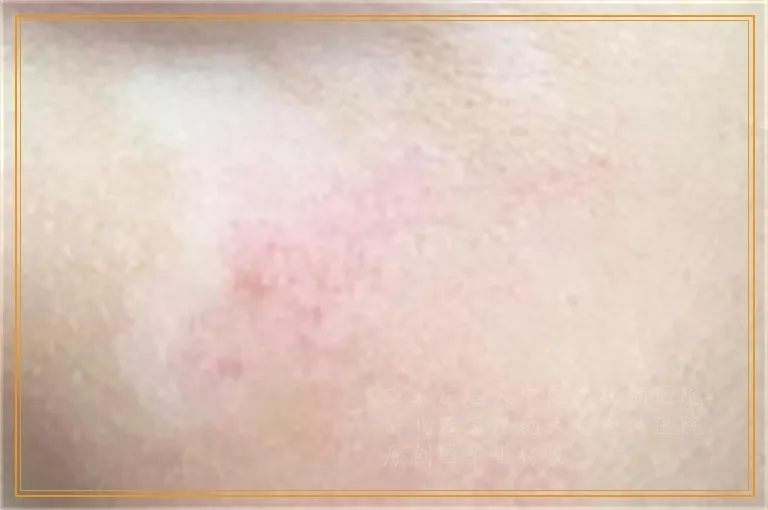 白癜风照光后好转的特征是什么