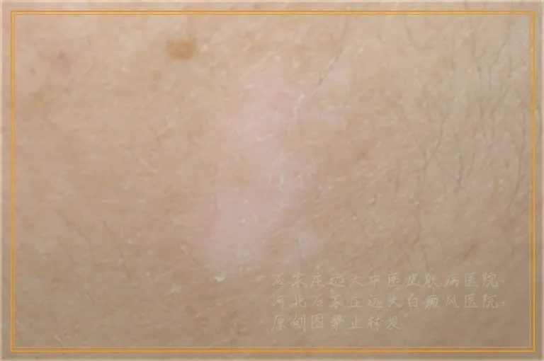 白癜风激光治疗白斑会复发吗