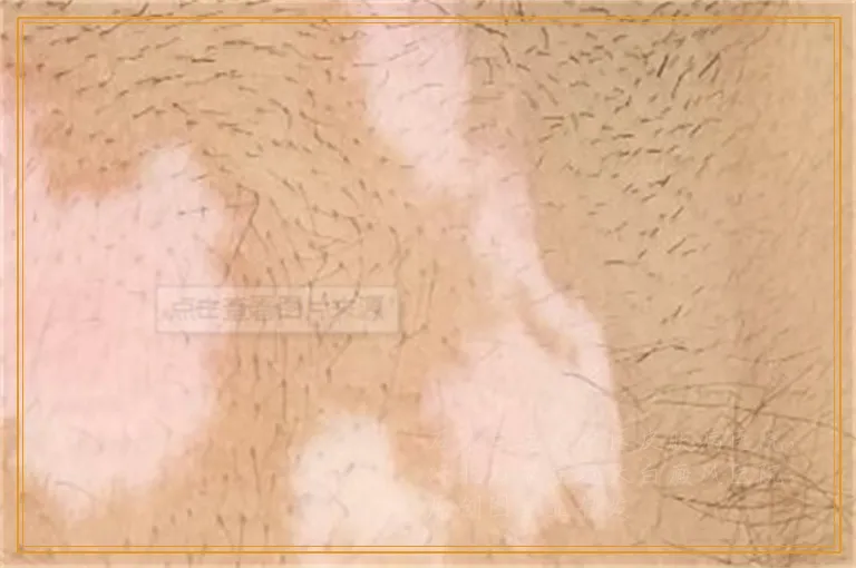 白癜风抹药膏后发红是正常现象吗