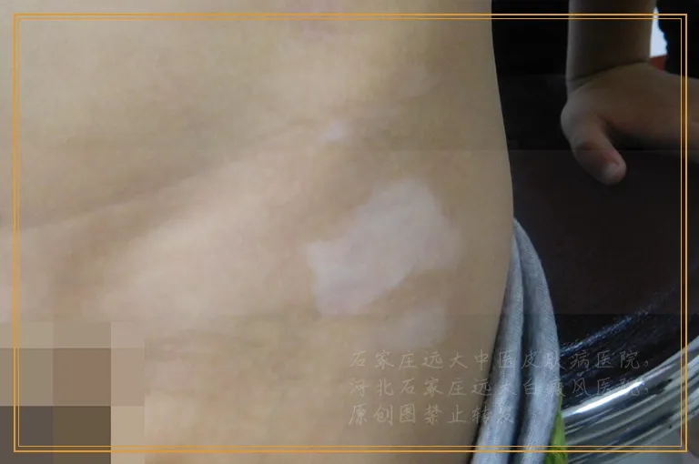 求治疗白癜风比较有名的一位医生