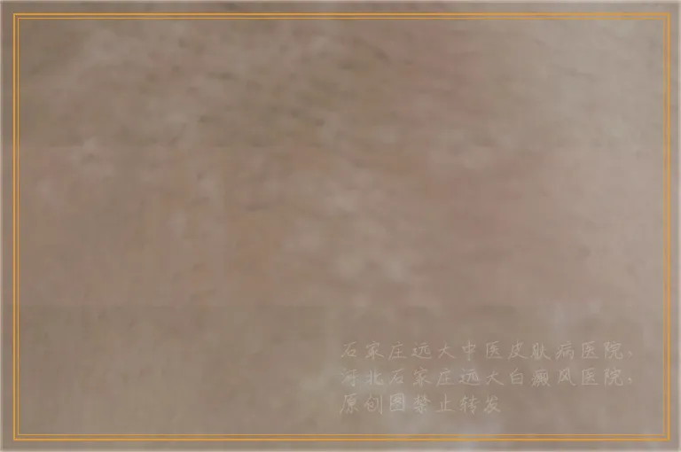 手臂上刚发现有块白癜风如何抗复发治疗