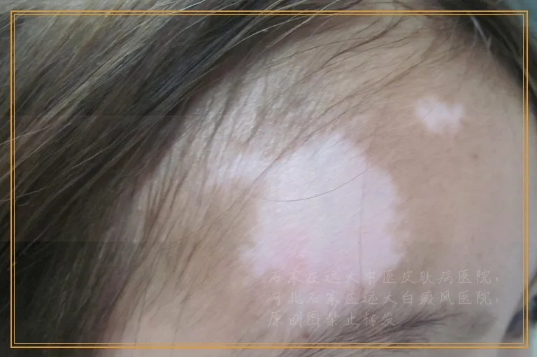 小块白癜风照光不变红怎么回事