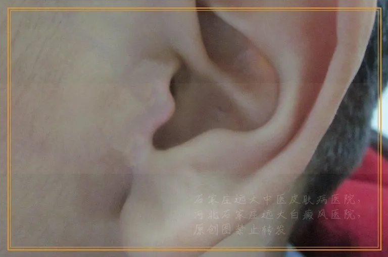 单纯照光能控制住白癜风吗