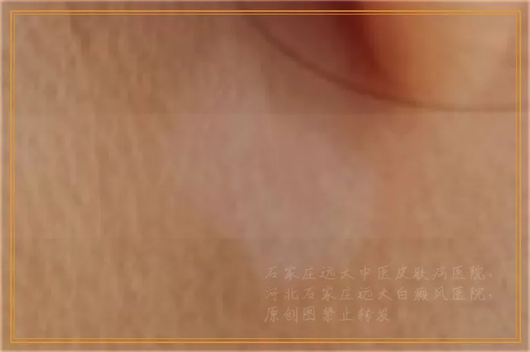 白癜风没治疗怀孕的话会复发吗