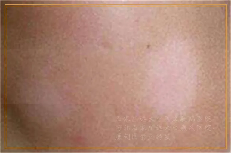 白癜风发展期照激光能控制住吗