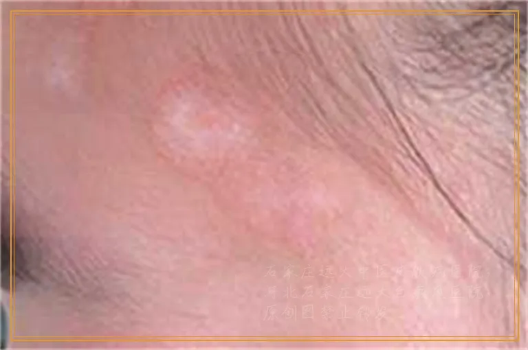 白癜风控制不住应用什么激素药好