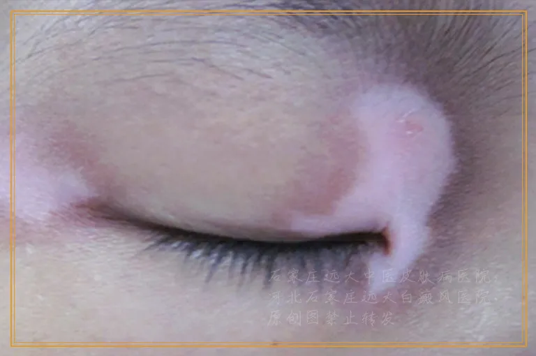 白癜风做完激光起水泡还能不能照光