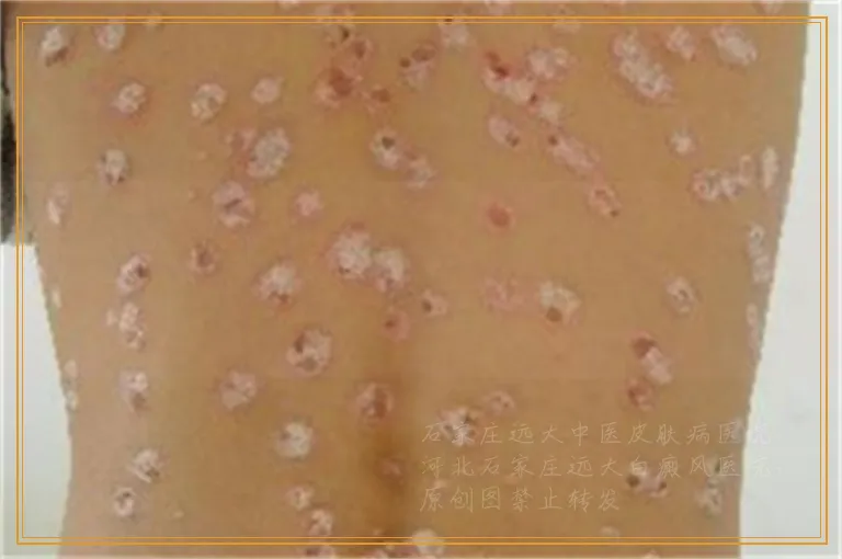 白癜风一个星期照一次激光行吗