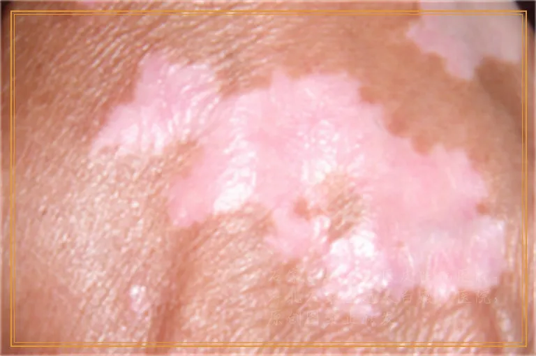 白癜风照光的时候爆皮了该咋办啊