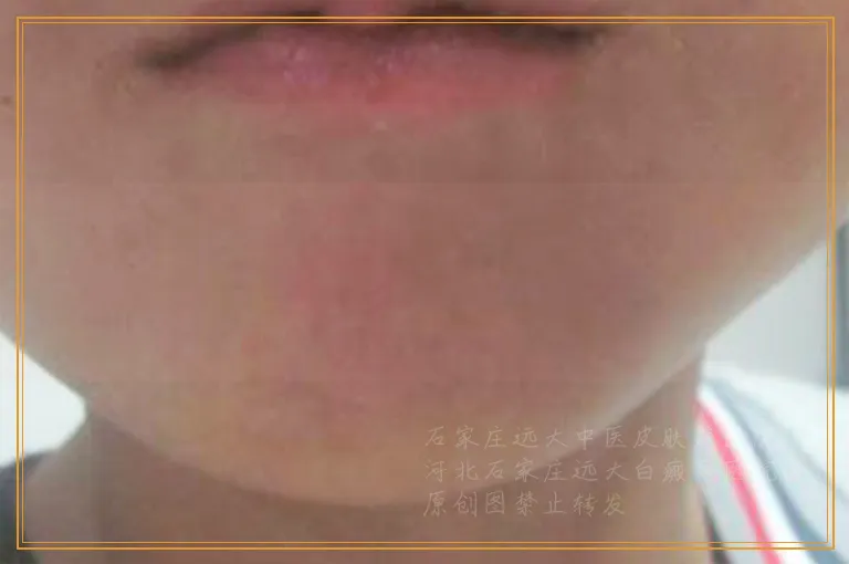 进展期白癜风激光治疗效果图