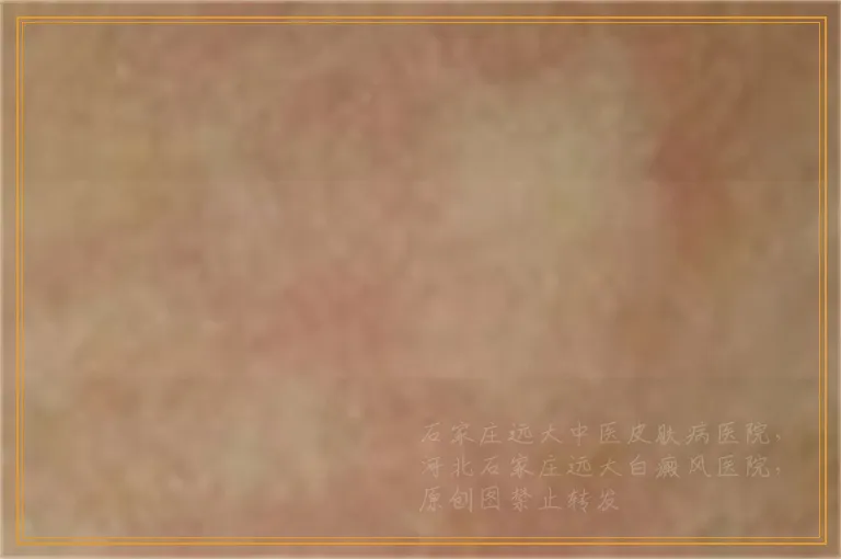 植皮治疗白癜风掉皮后可以用香皂水搓搓吗