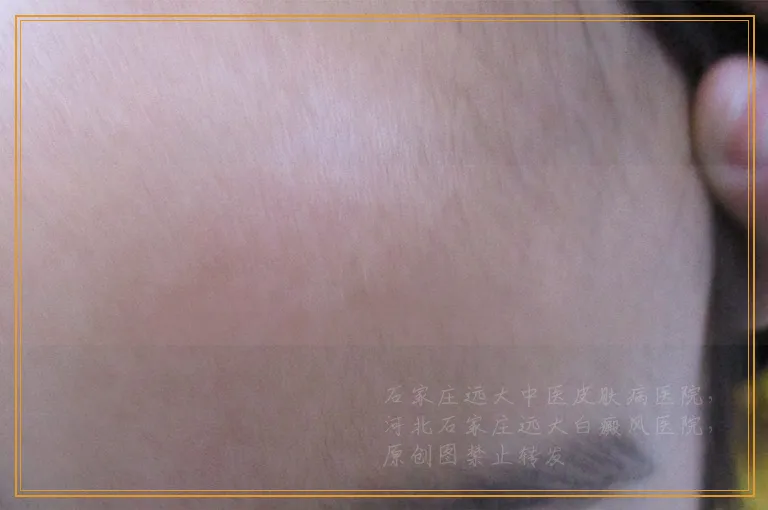 白癜风不及时治疗会越来越多吗