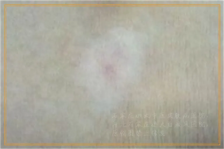 小面积早期白癜风照激光