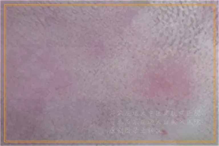 高中生治疗白癜风效果怎么样