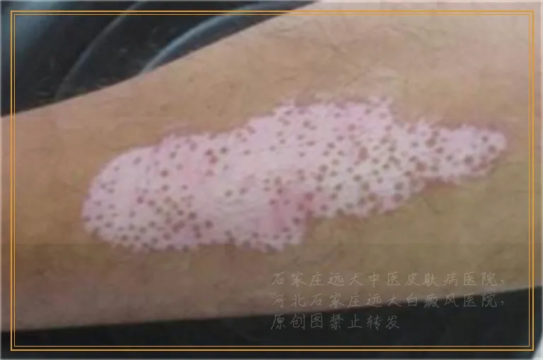 白斑照光后红肿还脱皮是好还是不好