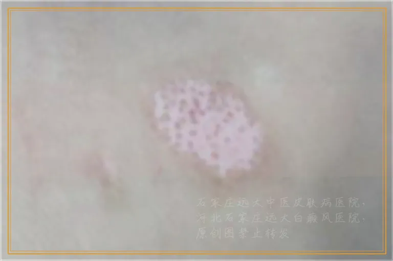 白癜风照光很长时间了就是不见好 白癜风医生指点你