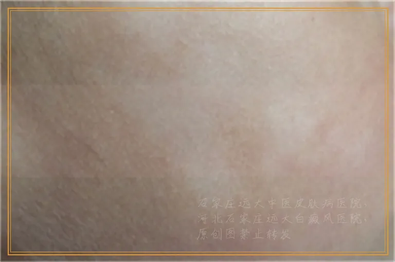 白癜风照光以后白斑沾水了有影响吗