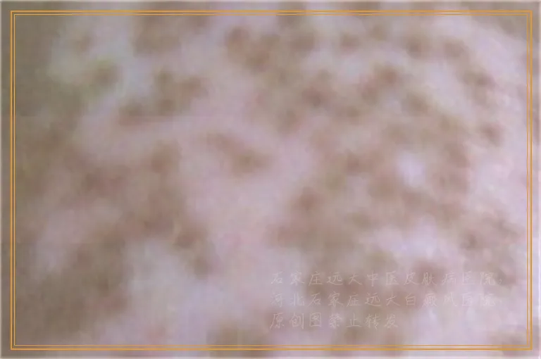 肚脐附近长白癜风照光好的快吗