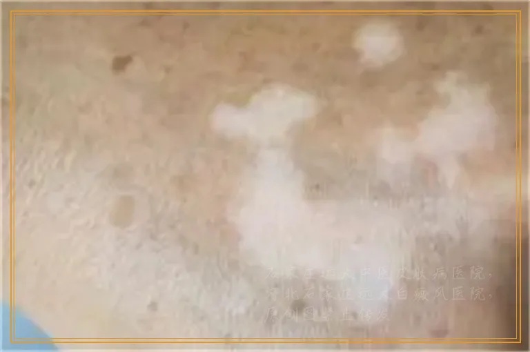 腿上长了好多小白斑照光能好吗