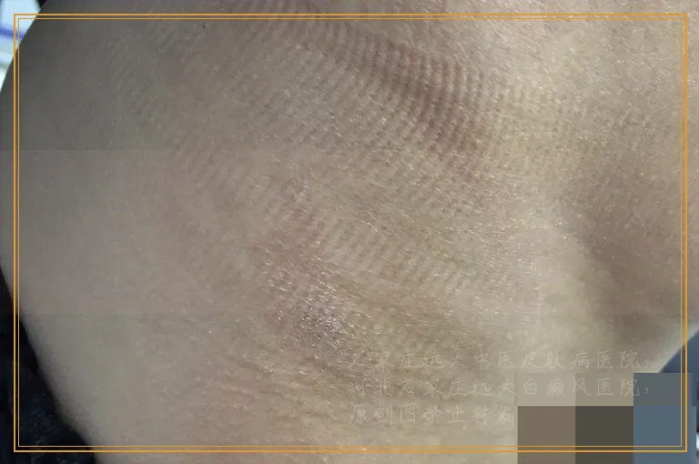 白癜风照光能除根吗