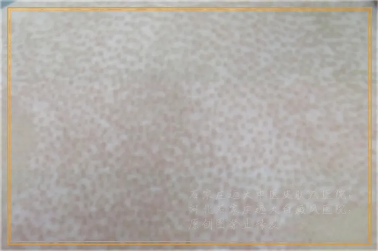 白斑涂他克莫司后反而白斑扩大怎么办