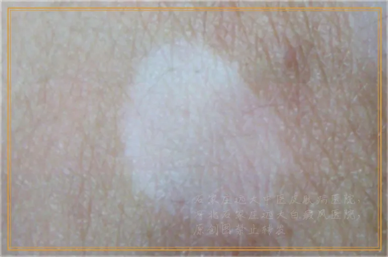 再次出现的白癜风纯靠药物治疗能好吗