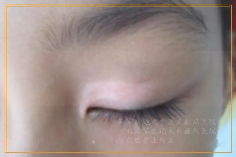 白癜风刚照完激光能去游泳吗