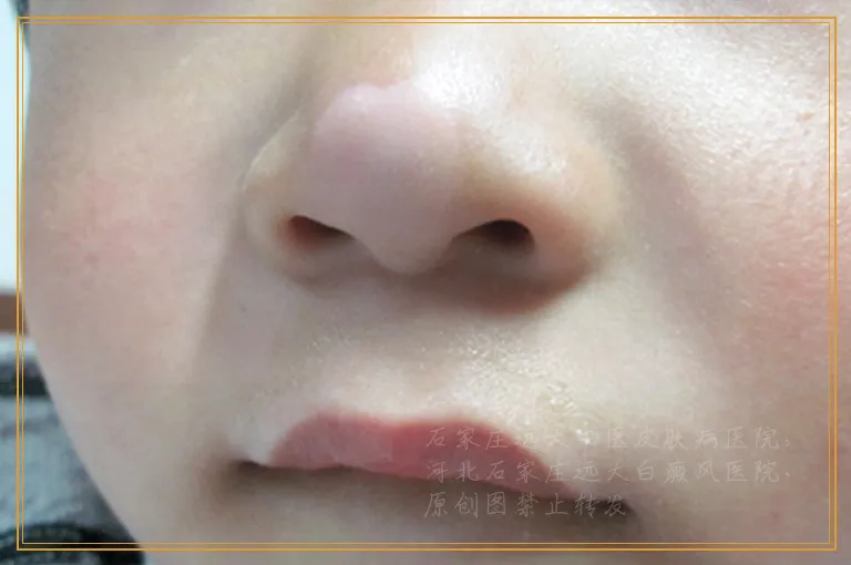 眉毛处白癜风照激光会伤害到眼睛吗