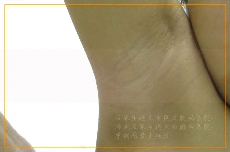 激光照白癜风脱皮是怎么回事