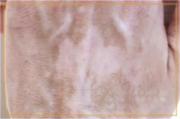 脸上白癜风一照光就红肿怎么办