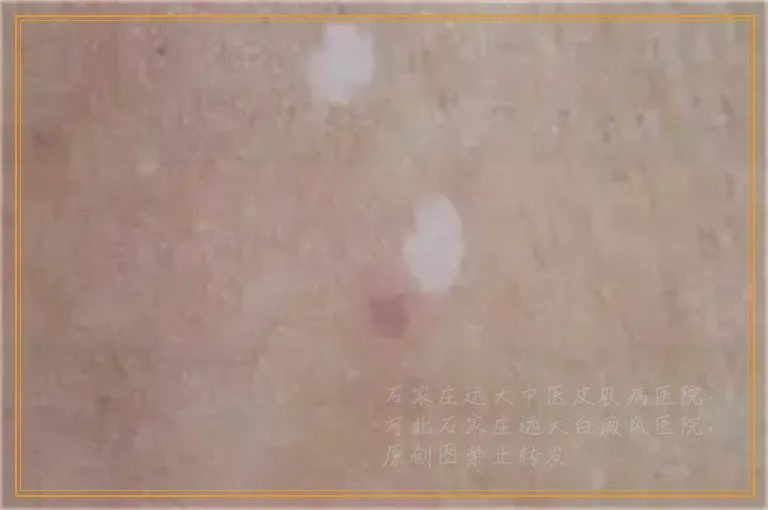 治疗皮肤白斑长期照激光怎么样